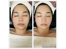 BBC 田園調布の雰囲気(小顔になった!フェイスラインすっきり!顔全体トーンアップ!)