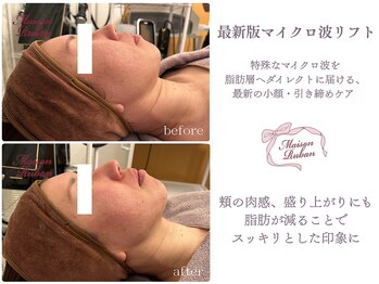 メゾンリュバン 梅田店(Maison Ruban)/最新版小顔マイクロ波リフト