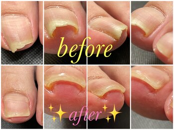 ラピス(Lapis)/高技術巻き爪ケア!!