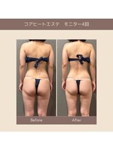 エクラ(ECLAT)/コアヒート痩身