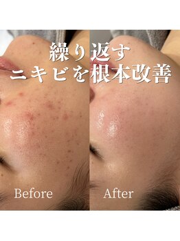 ルラシェ(Relacher)の写真/【繰り返すニキビ・肌荒れ】徹底改善◎肌育ハーブ・美容導入で透明感あふれるツヤ肌へ
