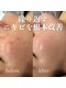 ルラシェ(Relacher)の写真/【繰り返すニキビ・肌荒れ】徹底改善◎肌育ハーブ・美容導入で透明感あふれるツヤ肌へ