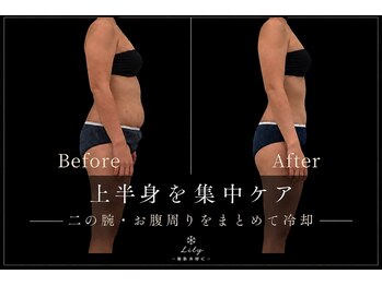 ビューティーサロン リリー(Lily)の写真/【最先端の脂肪冷却機完備◎】脂肪冷却/小顔冷却も◎/美ボディメイク♪