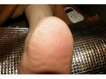 角質フットケアサロン リラックスパーク 大阪難波店(RelaxPark)/踵のガサガサ ひび割れ/角質除去