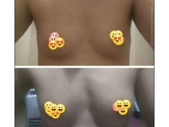 ソラ(SORA)/バストアップ症例