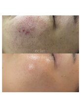 エクラ(eclat)/ハーブトリートメント