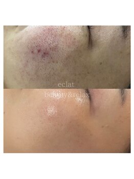 エクラ(eclat)/ハーブトリートメント