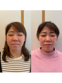 イロドリ 浦和美園(irodori)/小顔整体Before＆After(8回目)