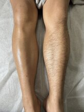 ディア(Dea)/メンズ脚脱毛