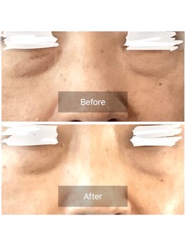 チャルム(CAL'ME)/レモンボトル・目の下