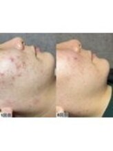 アンドミー 鹿児島中山(&me)/ハーブピーリング【ニキビケア】