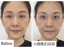 クロア ナゴヤ(Croire NAGOYA)の雰囲気（小顔矯正/光フェイシャル同時施術★たるみ/ほうれい線/老け顔）