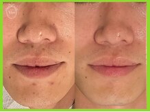 ハーブピーリング 名古屋/男性にも人気なハーブピーリング