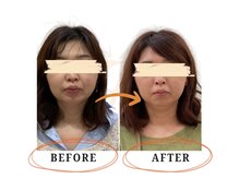 Risetto鍼灸院/肌質改善！