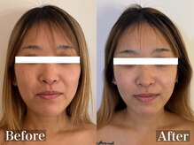 ラナ(Lana)/筋膜小顔リフト