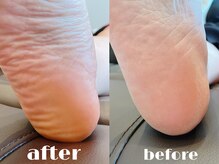 サロン ブルーム(Bloom)/足裏角質ケア