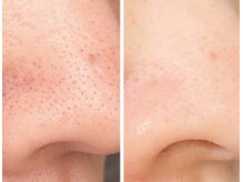 ママナ(mamana)/お顔全部毛穴スッキリ！