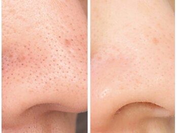 ママナ(mamana)/お顔全部毛穴スッキリ!