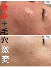 アリュール(ALLURE)/光ハイドロピーリングの施術効果