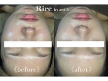 リル バイ アンドアール(Rire by and.R)/ララピール（施術1回）