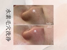 ビシア(Bicia)/水素毛穴洗浄