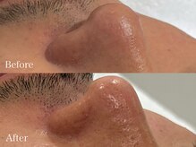 トム(Thom)/《毛穴黒ずみ》ハーブピーリング