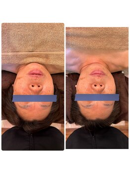 虹のひかり/小顔矯正