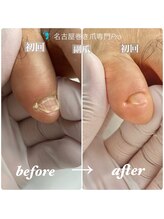 名古屋巻き爪専門Pro/名古屋で副爪ケア