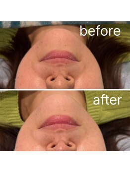 レイモード(Ray mode)/BBLフェイシャル＆パック