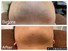 ビダン(BIDAN)/ヒゲ脱毛　BeforeAfter