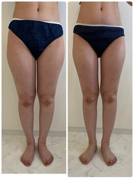 アンドモア(&more)/痩身症例