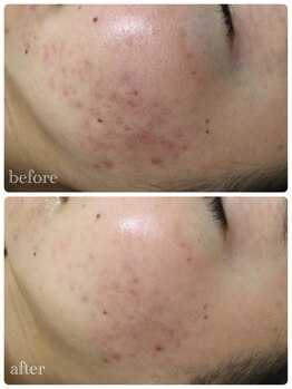 メイユール(MEILLEUR)/光フェイシャル2回目