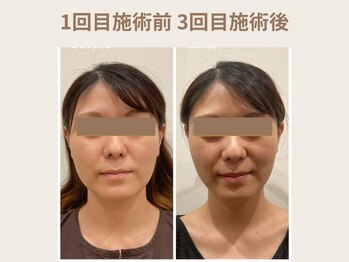 オムリス鍼灸接骨院/before after/美容鍼/駒込店