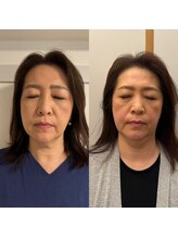 イロドリ 浦和美園(irodori)/小顔整体Before＆After(4回目)