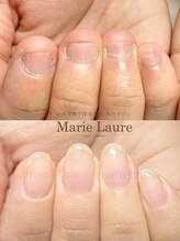 マリーロール 淀屋橋本店(Marie Laure)/自爪育成/深爪矯正/ネイルケア