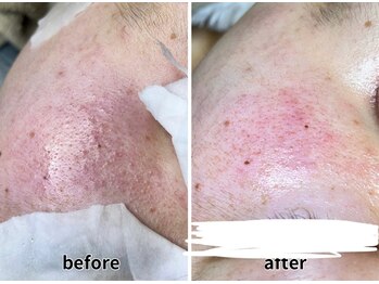 エヌエクラ(N.eclat.)/頬のざらつき、ニキビケア(１回)