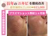 【長年のニキビ肌改善に】繰り返す肌悩みにプラズマシャワー！リピート価格有