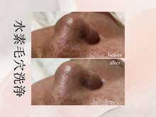 ビシア(Bicia)/水素毛穴洗浄