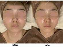 ピュアラ梅田/実際の施術例