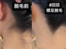 エスデザイン(es design)/LED脱毛/うなじ脱毛/襟足