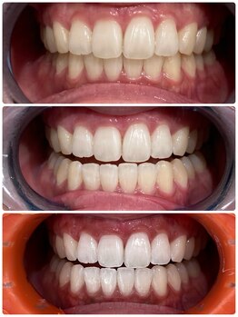 エクシアホワイトニング 日本橋店/学生ホワイトニング