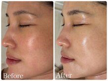 ロイヤル(ROYAL)/乾燥肌/敏感肌/赤み/改善症例