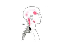 バズ カイロプラクティック(VAZ)/トリガーポイントによる頭痛