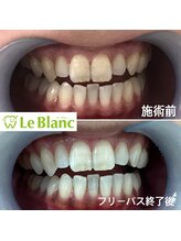 ルブラン 奈良店(Le Blanc)/夏休み中に白く！