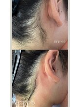 ケトリーナ/ブラジリアンワックス　うなじ