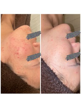 ルアンビューティー メディカルプラス(Luan beauty MEDICAL+)/ニキビケア