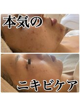 ビューティースタジオ ティー(Tiy)/本気でニキビをケアしたい方へ