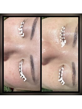 ココスタイルビューティー(COCOSTYLE beauty)/シミ改善し放題