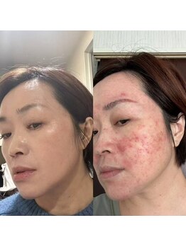 ベル(Bell)/ダイヤモンドスピキュール