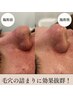 【根こそぎ解決】毛穴洗浄で素肌美人！